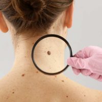 Best Mole Removal Reviews