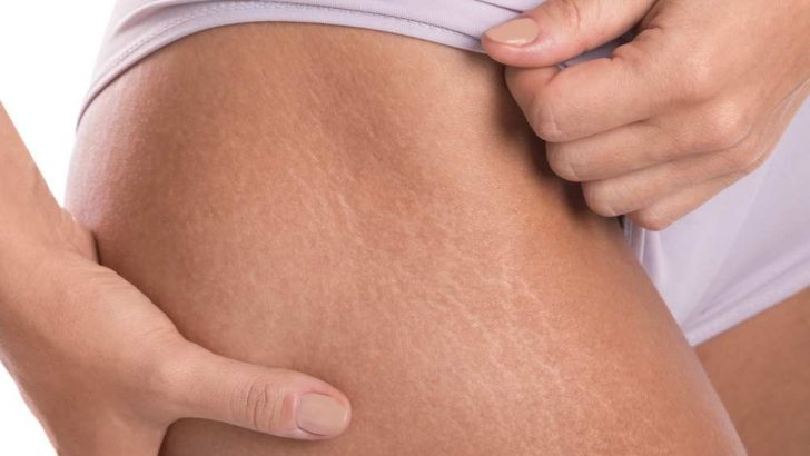 Does Spray Tanning Cover Stretch Marks?