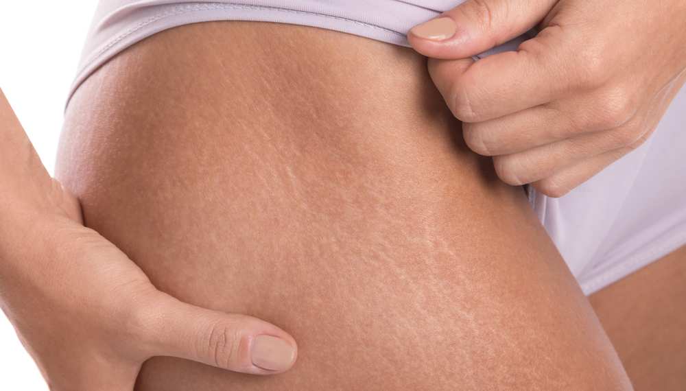 Does Spray Tanning Cover Stretch Marks